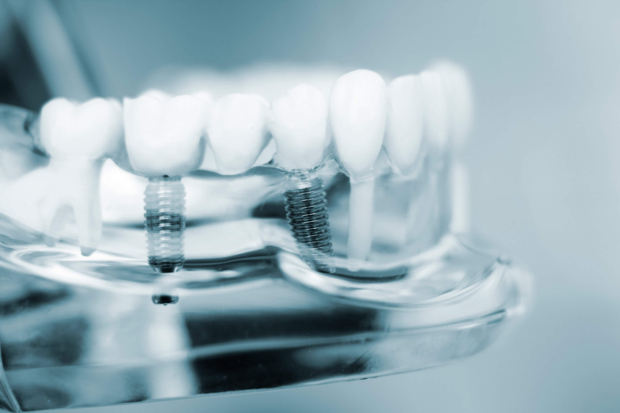 Dentists tooth plastic model with screw implant for teaching, learning and patients in dental office showing teeth and gums.