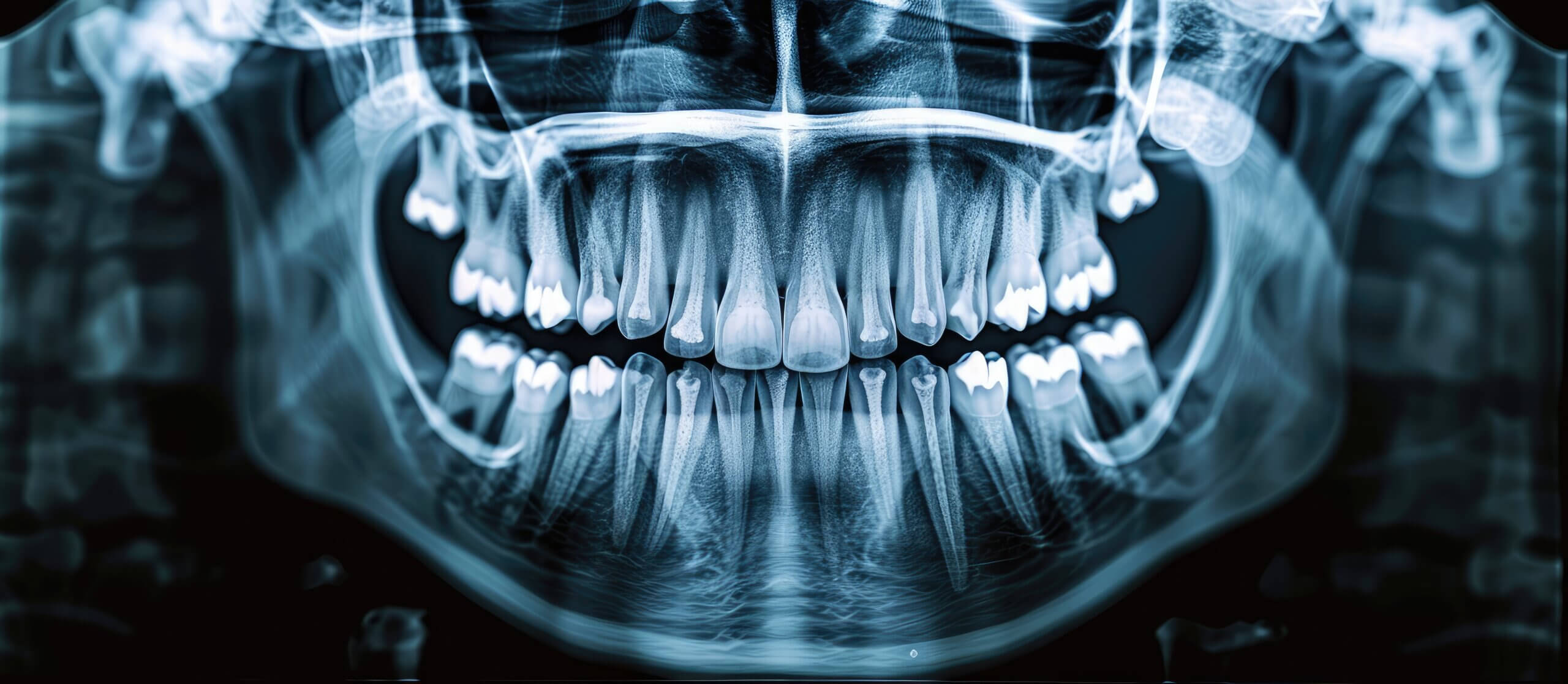 A panoramic x ray with dental implants in the lower jaw is displayed in the copy space image